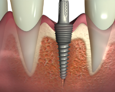 Mini-Implantate